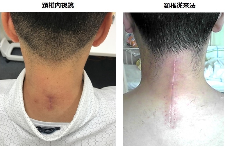 脊椎内視鏡手術と従来法の創部